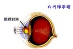 白內障眼晴