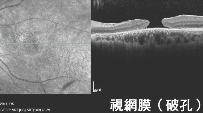 造成「視網膜血管病變」之主因為糖尿病患長期血糖控制不良，可能與下列變化有關：黃斑部水腫：黃斑部位於視網膜的正中心，是視力最敏銳之處，也是對於缺血最敏感的地區，當血流不順暢時，黃斑部容易水腫，感光的機能相對地變壞